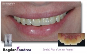 implant zirconiu ceramica