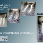 ace rupte canal