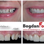estetica-gingivala-fatete-dr-bogdan-fondrea