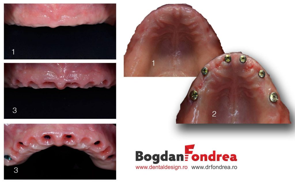 implanturi-dentare-ceramica-zirconiu-bogdan-fondrea