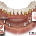 implanturi-dinti-implanturi-implantolog-bogdan-fondrea-dental-design-timisoara
