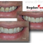 dinti ceramica dentist timisoara