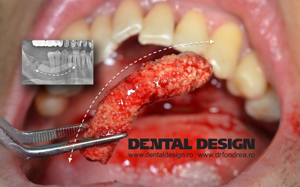 liteaza salivara, operatie dental design timisoara