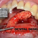 liteaza salivara, operatie dental design timisoara