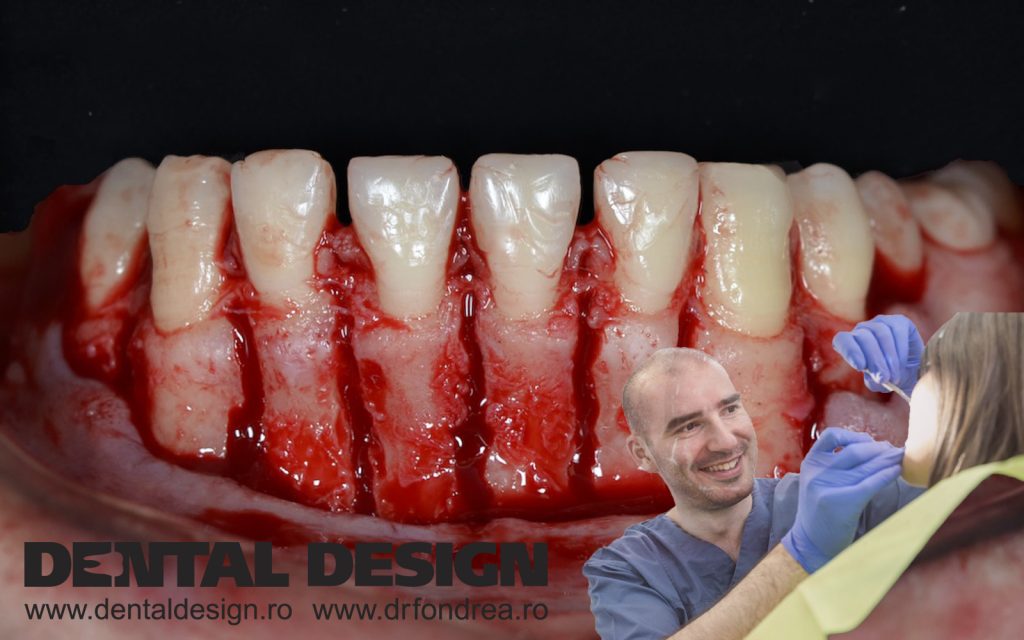 corticotomie dental design chirurg timisoara fondrea