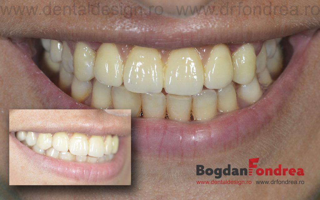 implanturi dinti fondrea timisoara clinica dentist