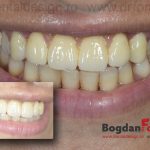 implanturi dinti fondrea timisoara clinica dentist