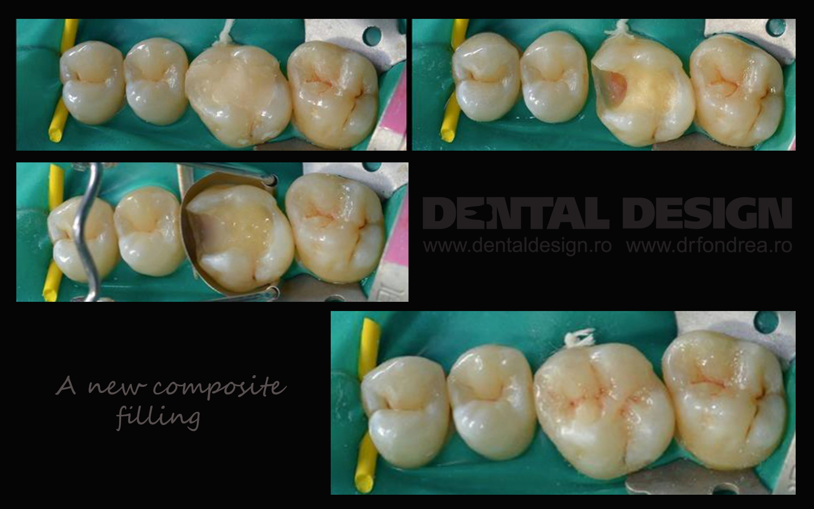 How is a composite filling made? Dr. Bogdan Fondrea