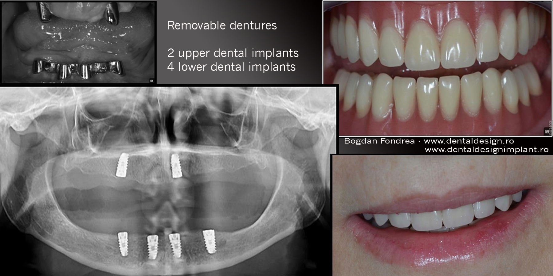 Clinica Dental Design Timisoara - pret implanturi dentare