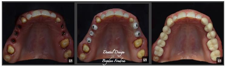 Lucrarea Dental Design - implanturi, coroane individuale, zirconiu