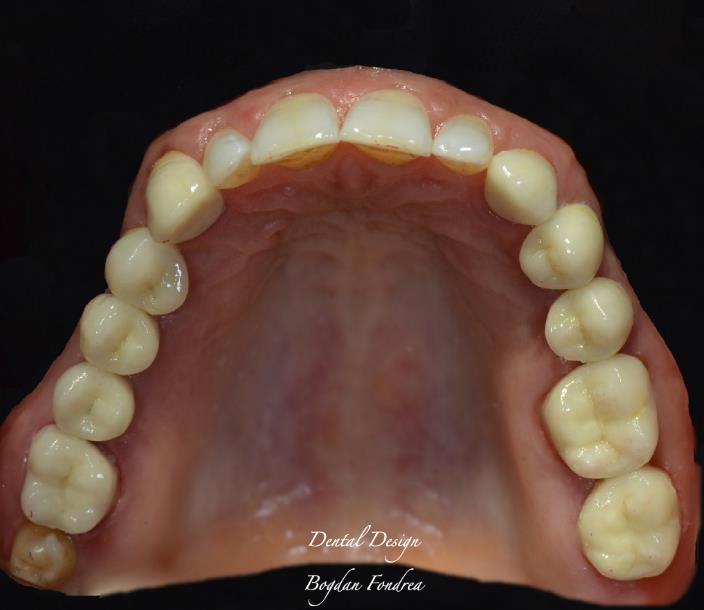 Lucrare Dental Design - implanturi, coroane individuale, zirconiu