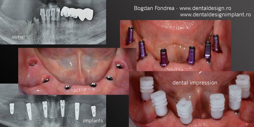 Implanturi dentare all on six