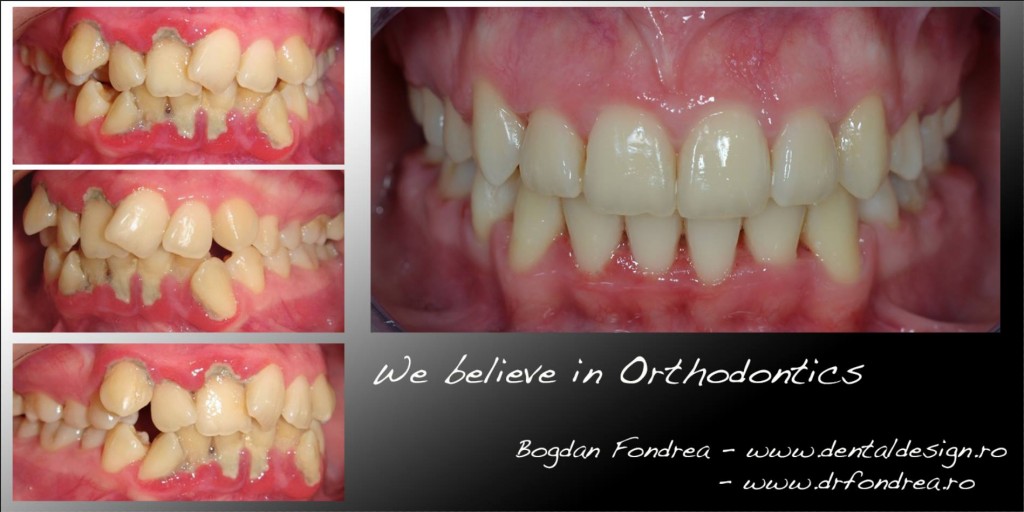 Tratament ortodontic