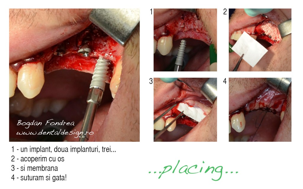implant dentar cu sinus lift