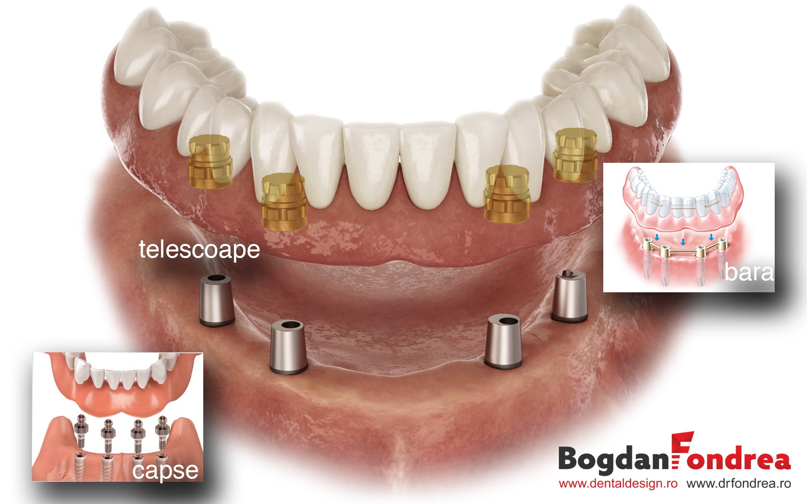 calm down dominate Filth Supraprotezarea cu sprijin pe implanturi dentare - Dr. Bogdan Fondrea