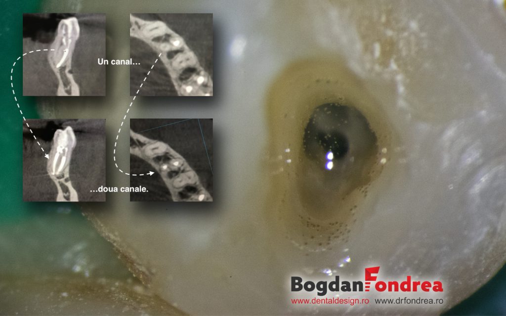 Karu mischief Completely dry Tratamentul endodontic 3D asistat de microscop - Dr. Bogdan Fondrea