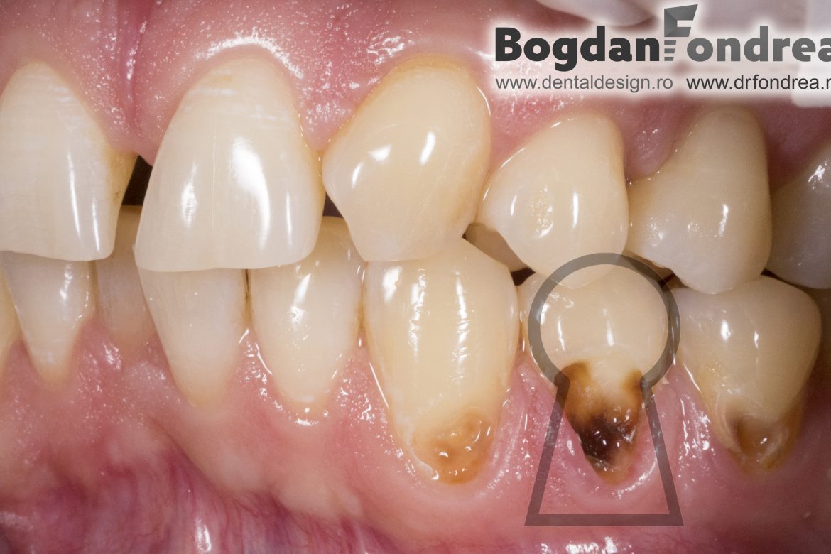 Endodontie Arhive Dr Bogdan Fondrea