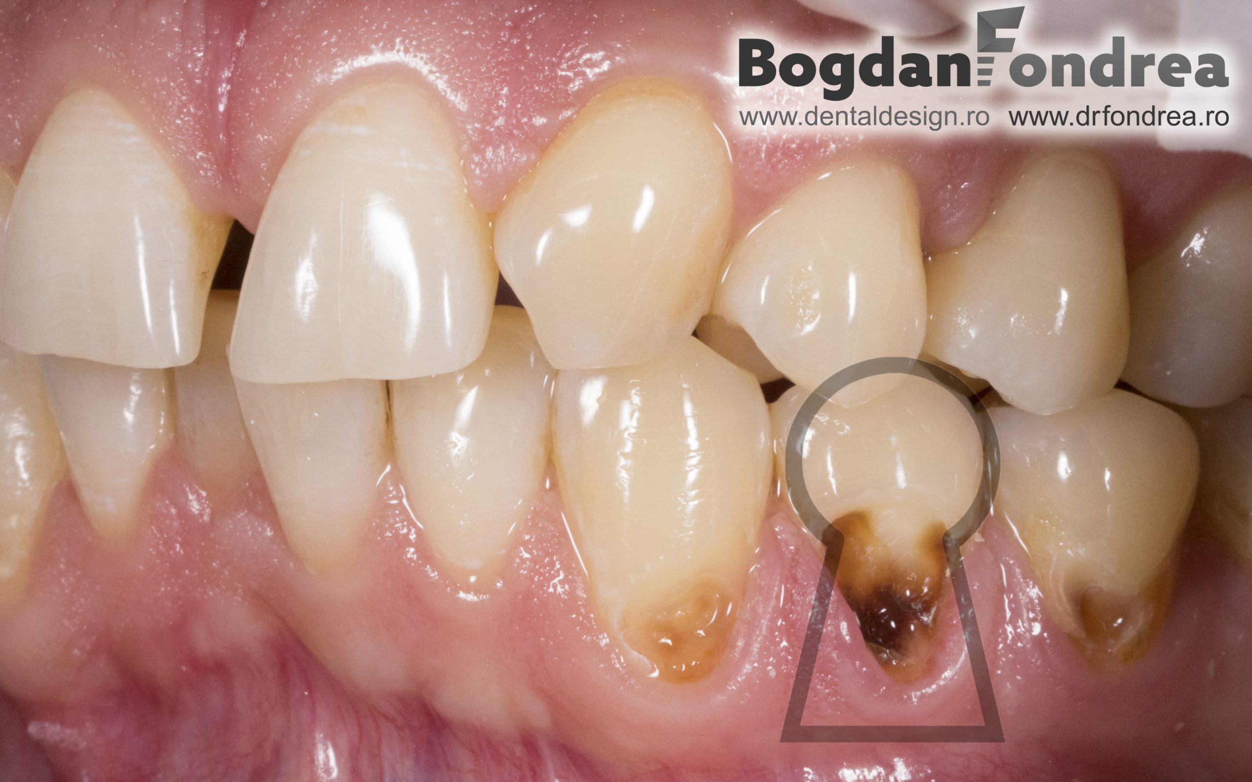 Tratament gingii dentist | Ingrijirea gingiilor | parodontax