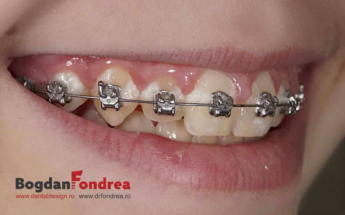 toxicity sort Trampling Igienizarea si intretinerea dintilor pe durata tratamentului ortodontic -  Dr. Bogdan Fondrea